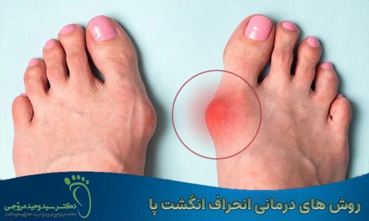 درمان هالوکس والگوس