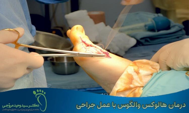 درمان هالوکس والگوس با جراحی