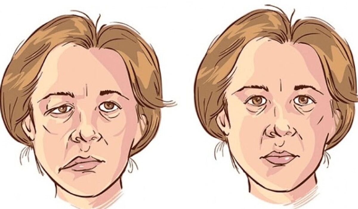 اختلالی که در زنان بالای 40 سال شایع تر است و سمت چپ صورت را درگیر می کند (+عکس)