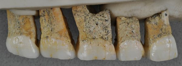 دندان گونه جدید انسان با قدمت 50 هزار ساله در فیلیپین