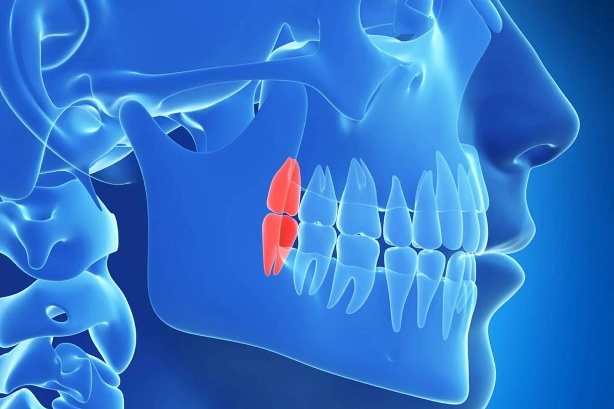 چرا انسان‌ها دندان عقل دارند؟