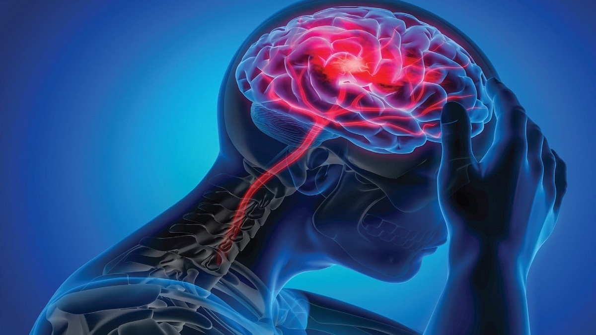 متخصص مغز و اعصاب : ۸۰ تا ۹۰ درصد سکته‌های مغزی قابل پیشگیری است