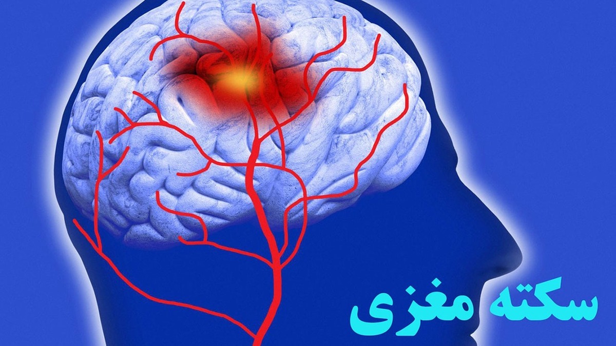 کاهش سن سکته مغزی در ایران