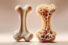 عواملی که باعث سرعت بخشیدن به بیماری پوکی استخوان می‌شود