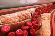 علائم چربی خون بالا که نباید ساده از کنار آن گذشت