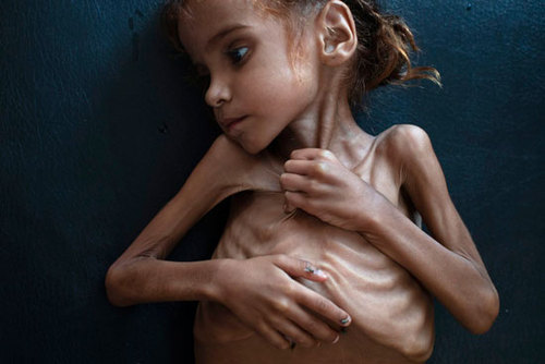 کودک یمنی که از سوء تغذیه رنج می‌برد ۲۰۱۸ 