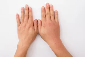 تورم انگشتان دست؛ چه زمانی طبیعی است و چه زمانی نیاز به بررسی دارد؟