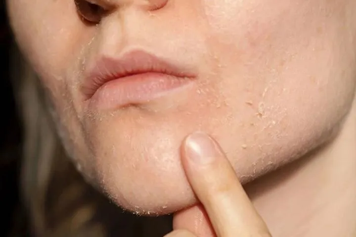 علائم خشکی پوست صورت
