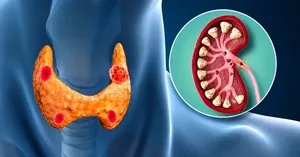 سنگ کلیه چرا ایجاد می‌شود؟ مهم‌ترین دلایل تشکیل سنگ در کلیه