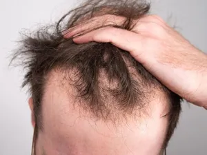 کمبود ویتامین‌ها چگونه باعث ریزش مو می‌شود؟